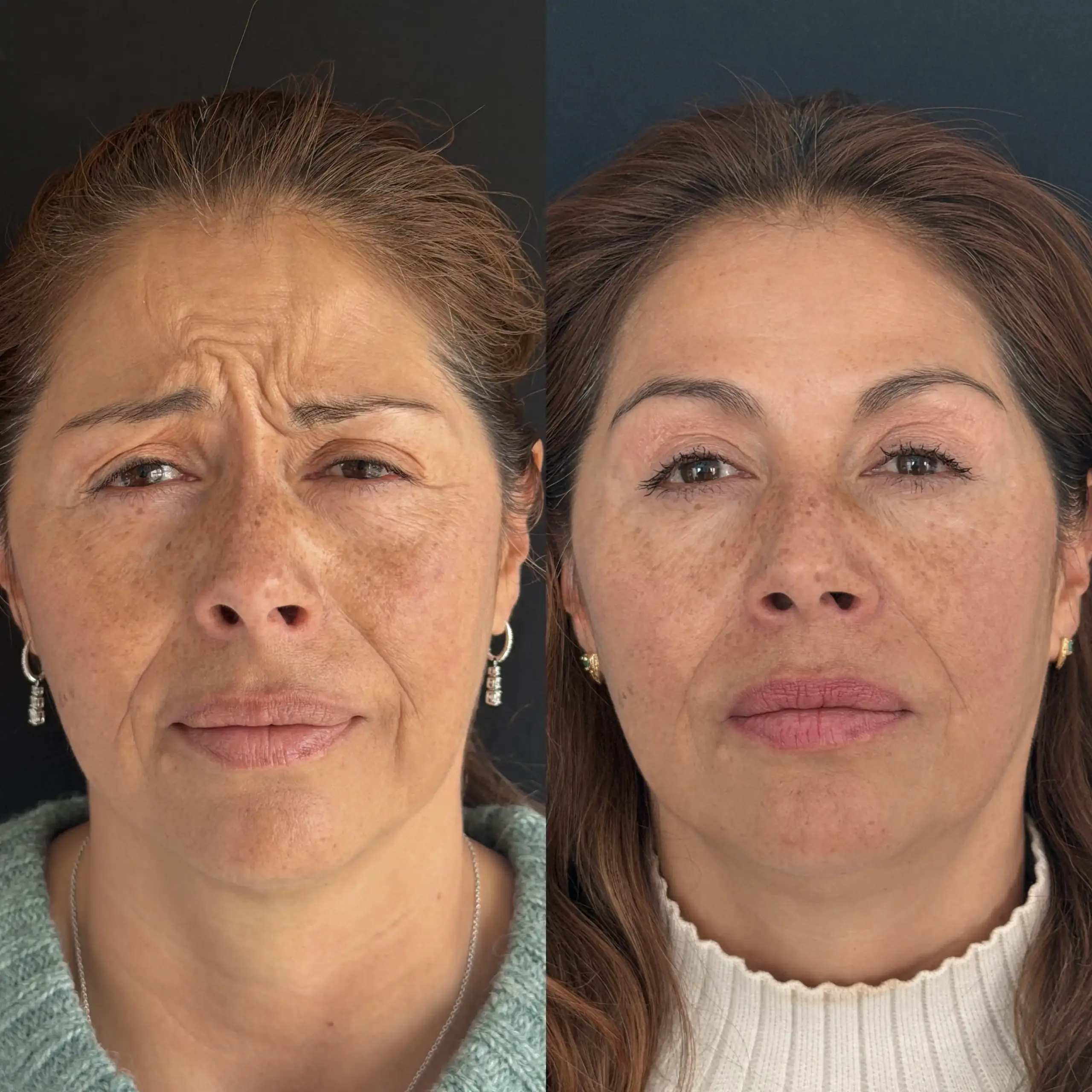 botox 1