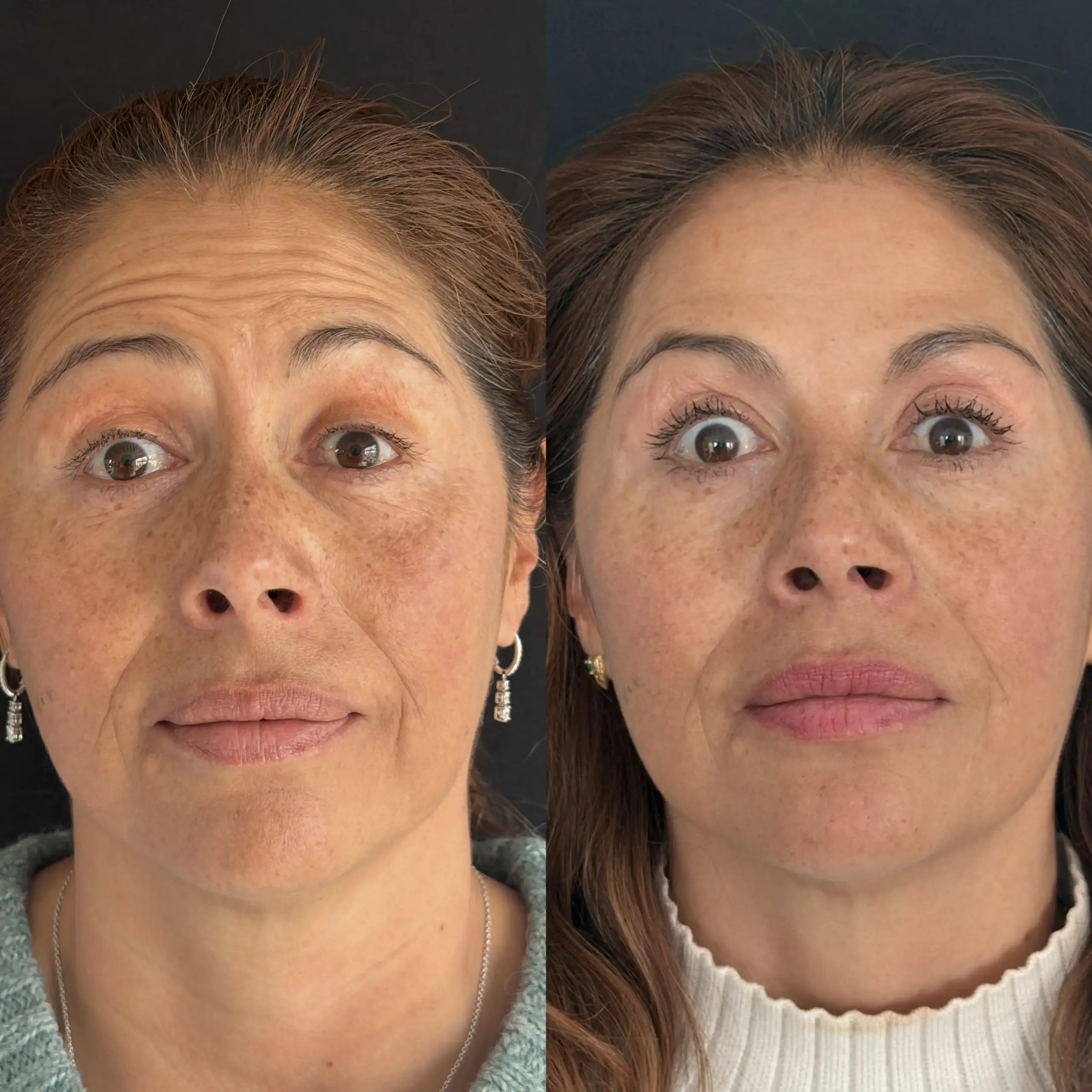 botox